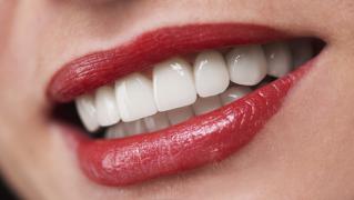 Porcelain Veneers